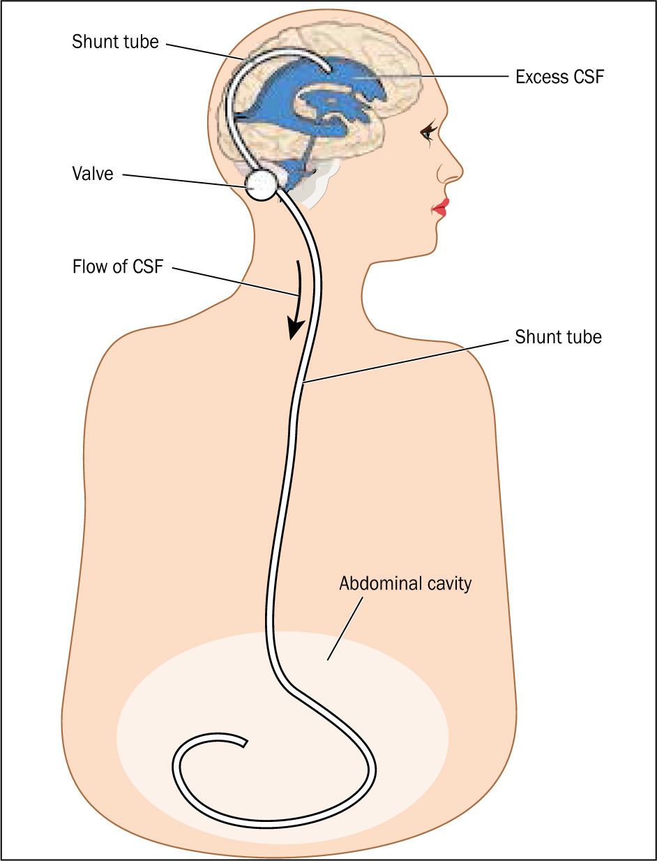 British Journal Of Midwifery - Cerebrospinal fluid shunts in the