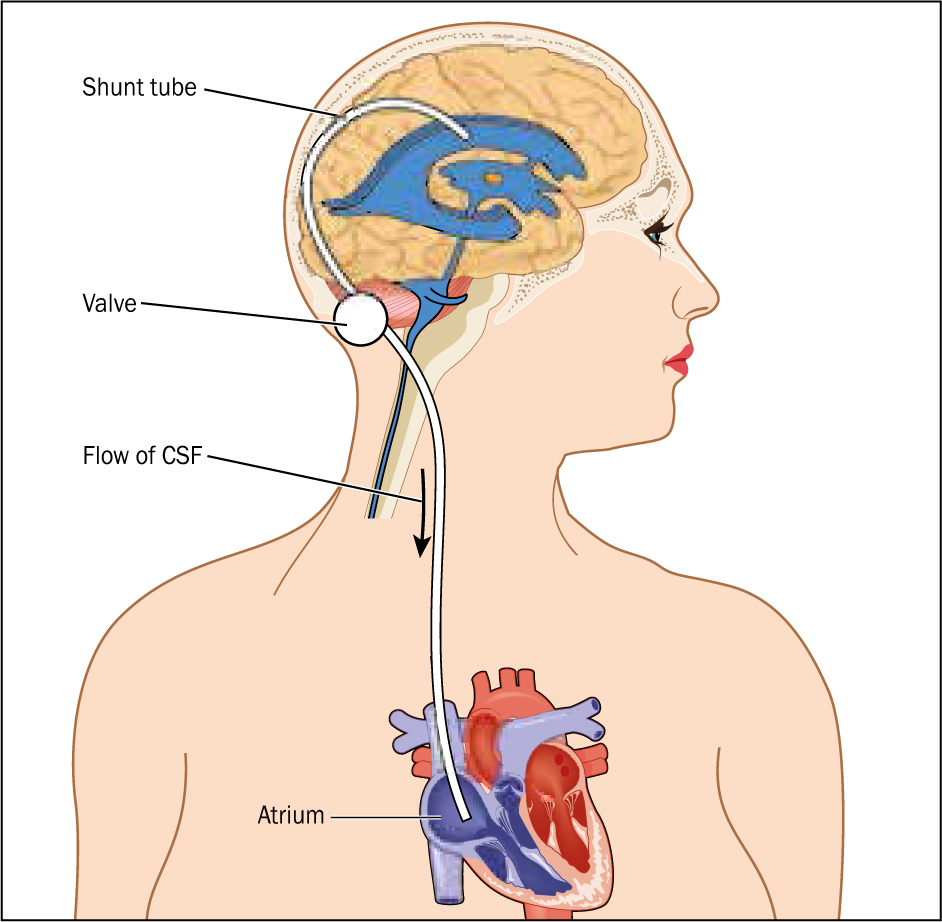 Ventriculoperitoneal (VP) Shunt - Together by St. Jude™